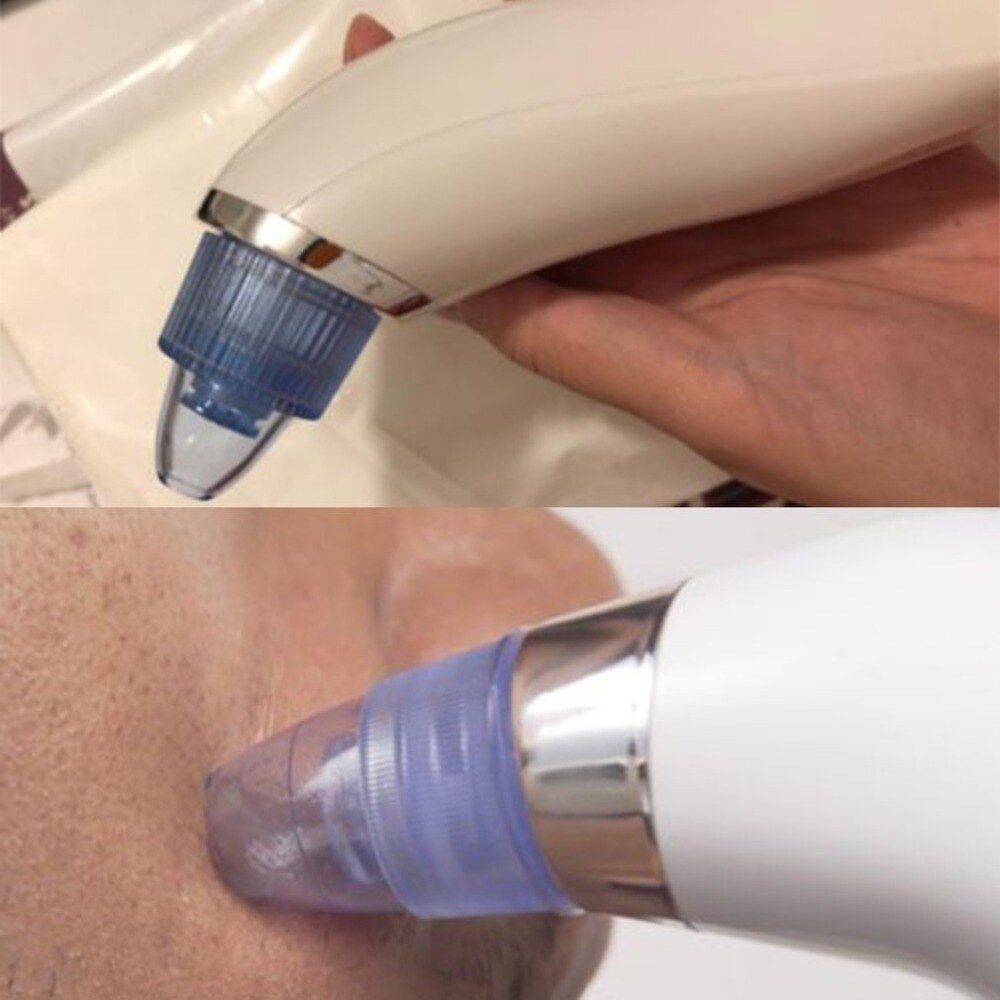 Blackhead Remover Vaccum Suction